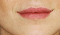 Full Lips AFTER