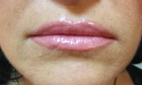 Full Lips/Correction AFTER