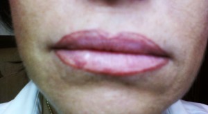 Full Lips/Correction BEFORE